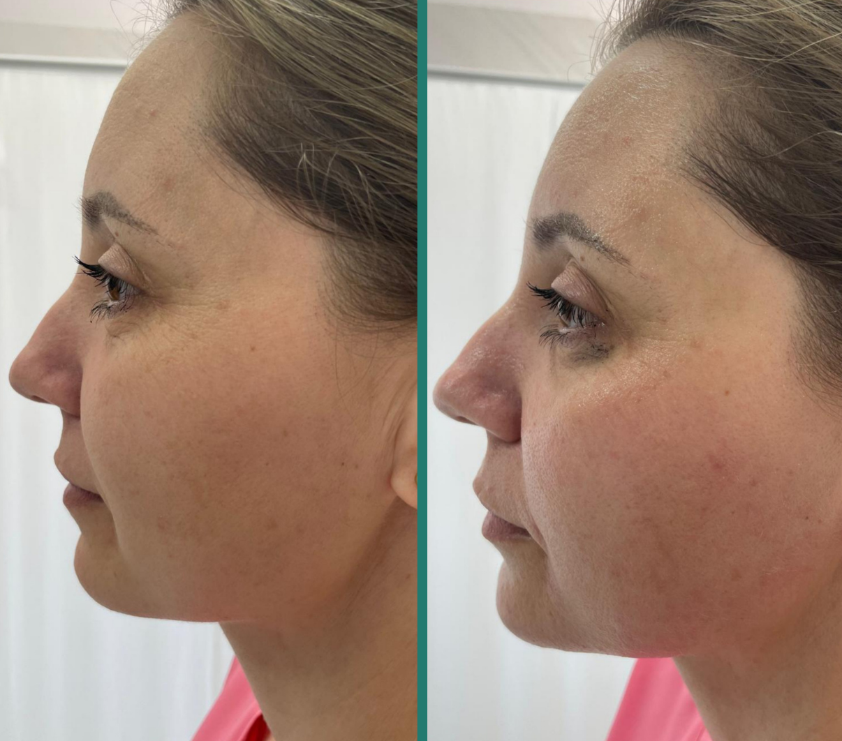 Rezultat rejuvenare facială Fotona 3D — 1