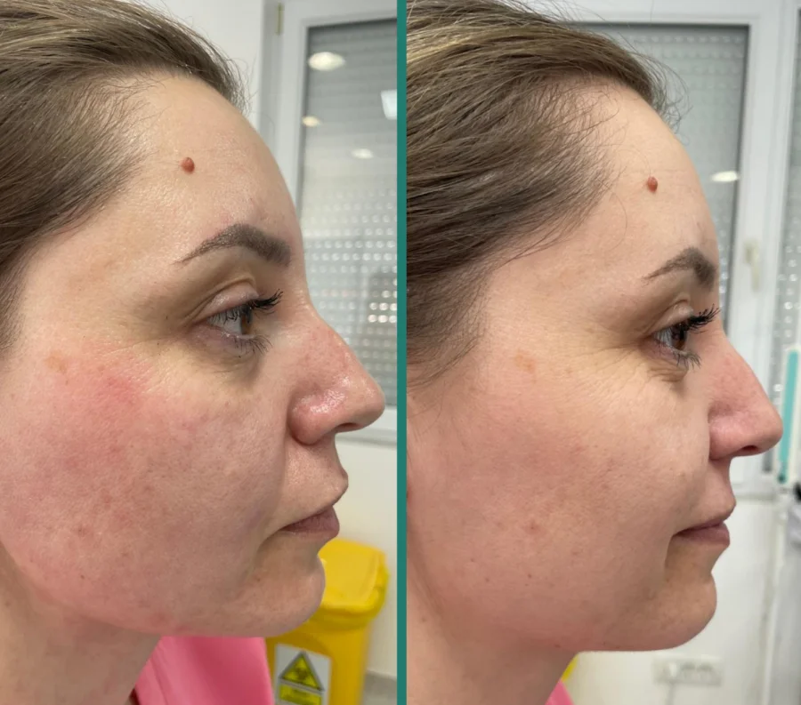 Rezultat rejuvenare facială Fotona 3D — 2
