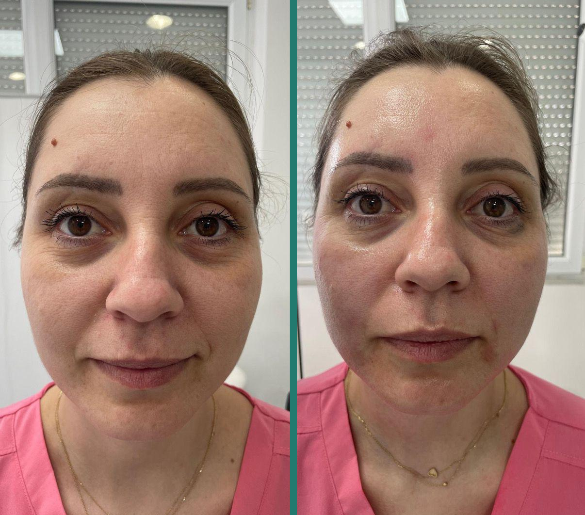 Rezultat rejuvenare facială Fotona 3D — 3