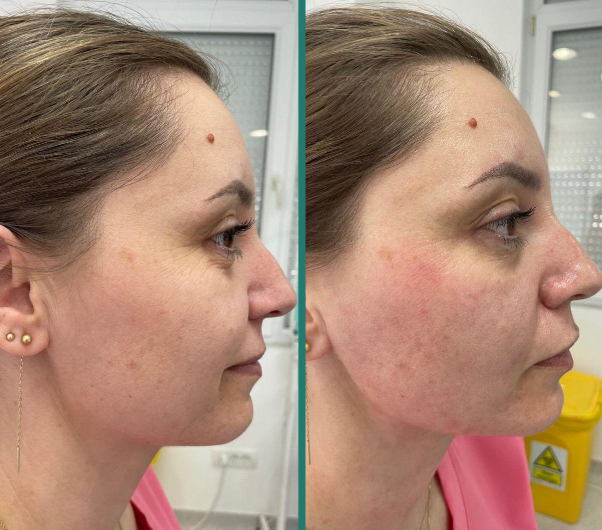 Rezultat rejuvenare facială Fotona 3D — 4