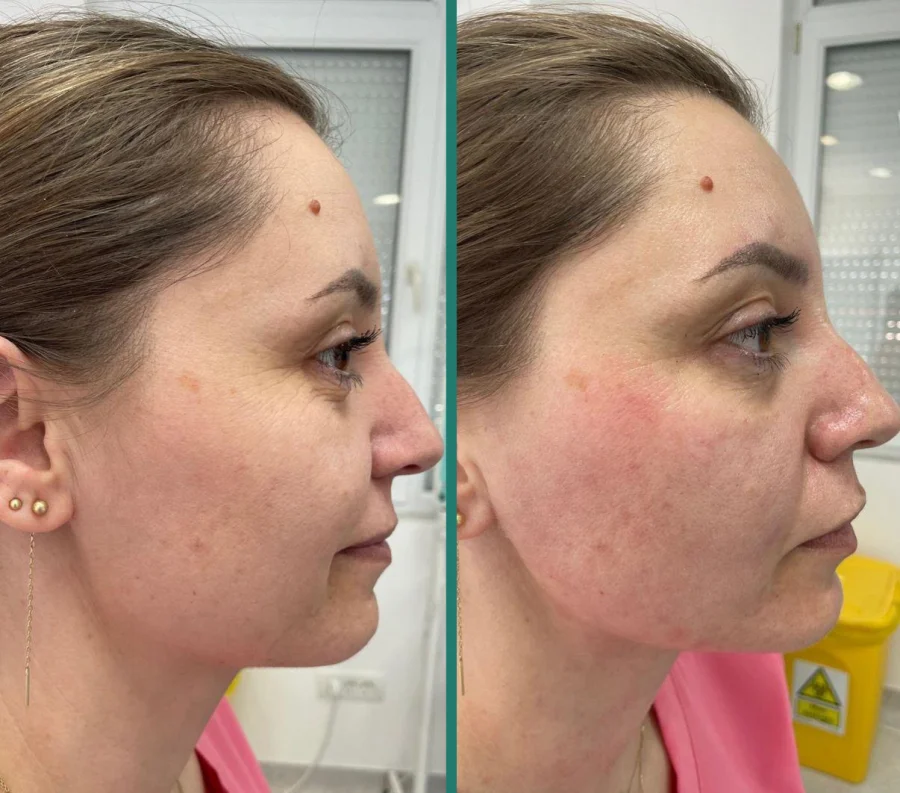 Rezultat rejuvenare facială Fotona 3D — 4